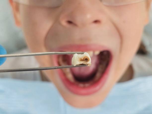 Best Emergency Tooth Extraction  in West Yarmouth, MA